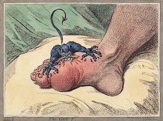 Gouty Foot